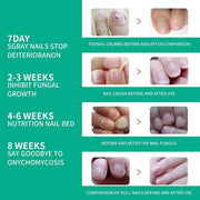 Nail Fungus Treatments Serum for healthy growth